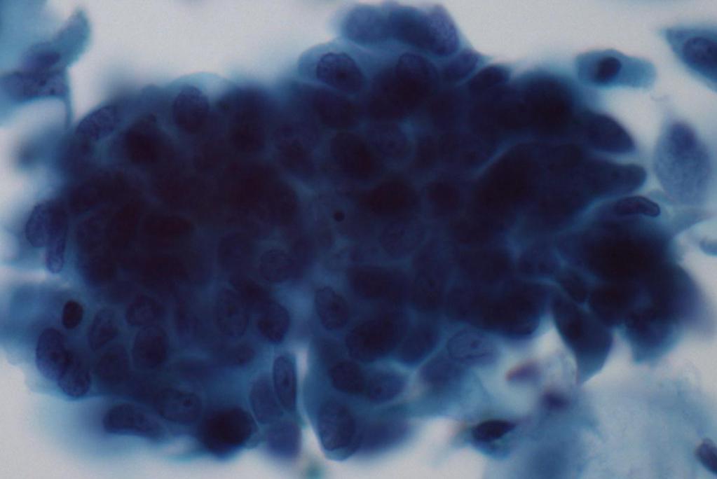 Cytologic Features 3 dimensional clusters of cells with small to