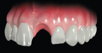 Today s patients expect longevity, function, and esthetics from their implant-supported restorations. 2.