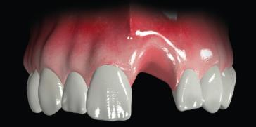 Fig 4 Fig 5 Fig 6 Figure 1-3: Single implant cemented restoration with a titanium gold nitrite coated abutment with an all ceramic crown.