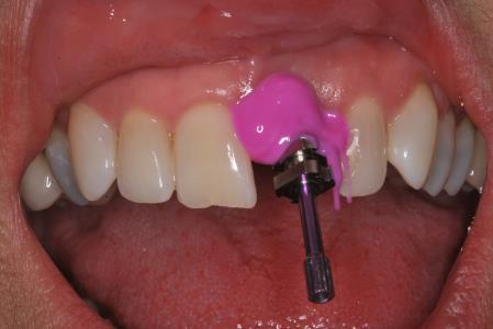 facilitated by the interim restoration to form the peri-implant mucosa.
