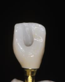 Eger et al compared clinical parameters such as probing depths, gingival level, gingival index, and mobility between implants restored with angled and standard abutments and found no significant