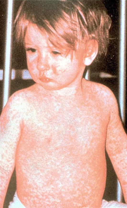 Measles Symptoms Incubation period 8-12 days Range of 7-21 days Symptoms first 2-4 days: Fever Cough Coryza