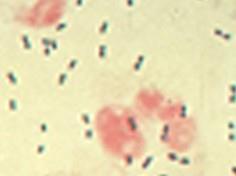 Bacterial diseases caused by Streptoccus pneumoniae in children Bactermia 85% Bacterial pneumonia 66% Bacterial