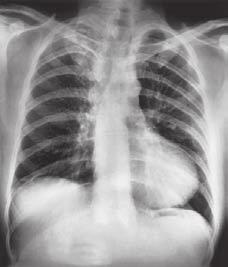 A chest radiograph showed that the wire from the pacemaker had broken under the clavicle. Anatomical knowledge of this region of the chest explains why the wire broke.