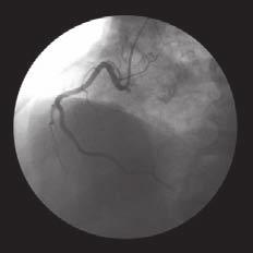 Regional anatomy Mediastinum 3 A Left coronary artery Sinu-atrial nodal branch of right coronary artery Left auricle Circumflex branch of left coronary artery Right coronary artery Right atrium Right