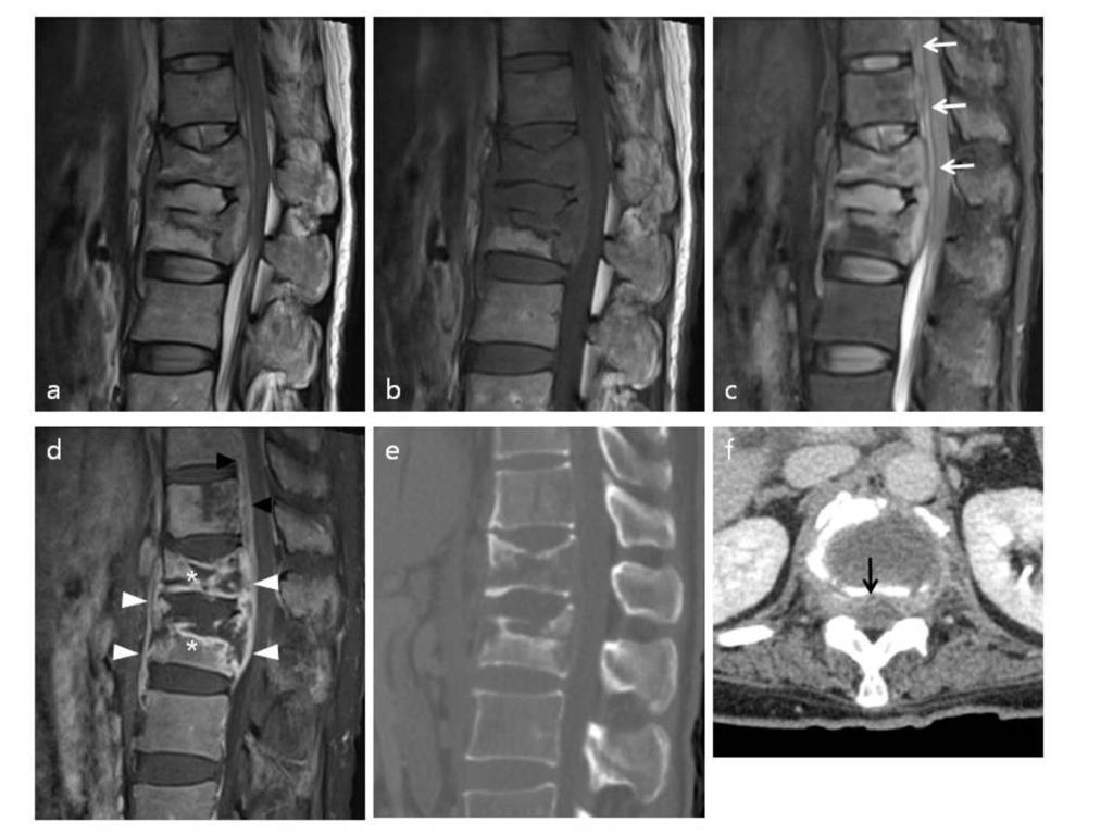Fig. 7: Epidural abscess. 53-years old female was performed MR and CT imaging for lower back pain.