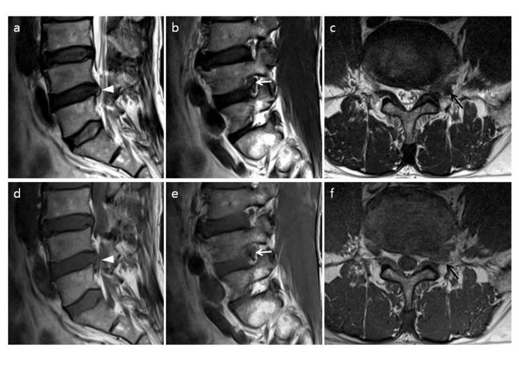 Fig. 8: Sequestrated disc. 63-years old male was perfored MR imaging due to lower back pain.