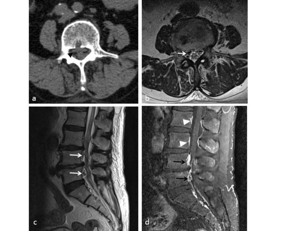 Imaging finding of the related structures Epidural abscess is usually combined with spondylodiscitis, so imaging findings of spondylodiscitis such as bone marrow edema, bony erosion, or inflammatory