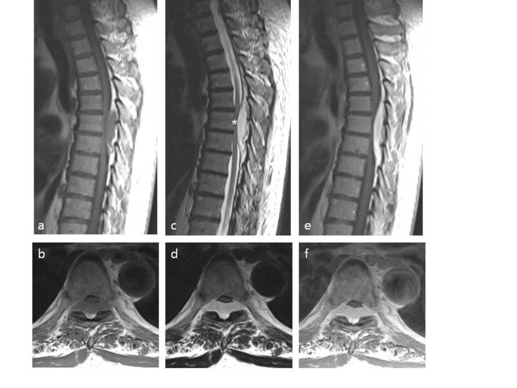 Fig. 5: Epidural cavernous hemangioma. 65-years old male was performed T-spine MR imaging due to lower back pain.