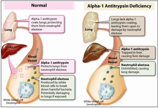 Alpha-1 Antitrypsin Deficiency The liver doesn t produce enough functional AAT, and neutrophil elastase