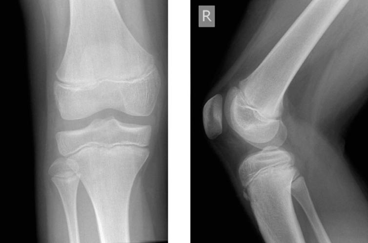 Plain X-rays of the knee AP and