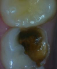 Caries Prevention Sealants should be placed in pits and fissures of primary and permanent