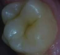 caries Noncavitated Carious Lesions Sealants should be placed on early (noncavitated)
