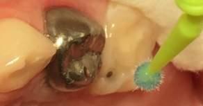 Recommended UoM Technique 1. Discuss with your patient and obtain consent. 1. Open uni-dose 38% SDF. 2. Isolate the carious tooth and dry the area (to avoid diluting the SDF). 3. Remove any food debris (there is no need to remove carious tissue).