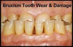Indications Prevention of dental caries (once or