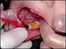 1- Cleaning teeth. 2- Apply varnish by brush. Indication - high risk group.