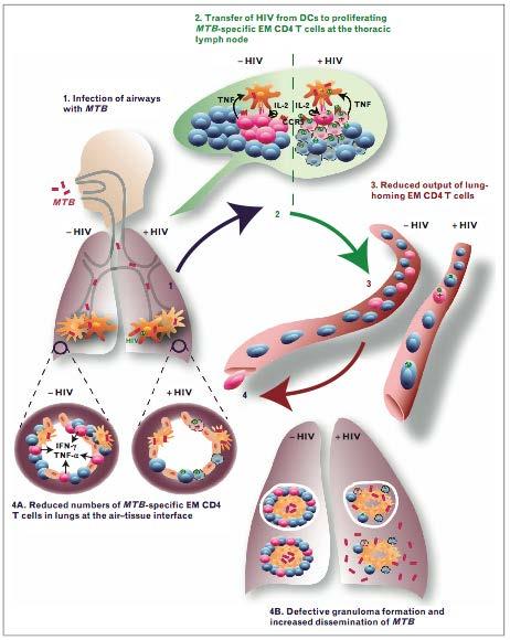 HIV kills TB-specific CD4 cells Impairs macrophage activation Fewer lung-homing CD4 cells