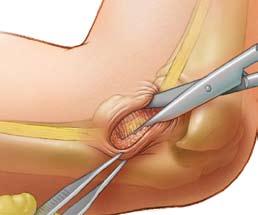 Mark out an approximate 2cm incision over the cubital tunnel, posterior to the medial epicondyle (Figure 1-1).