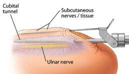 Lift the skin and subcutaneous tissue and insert the Obturator and Cannula into the cubital tunnel and advance it proximally between the ulnar nerve and the roof