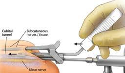 5-1 5-2 Step 5 Incision of the Fascia - Proximally Insert the Blade into the slot on the Cannula (Figure 5-1). Use the endoscope to visualize the fascia and the Blade.