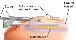 7-1 7-2 Step 7 Endoscopic Visualization - Distally Insert the endoscope between the Cannula and Retractor to confirm that no superficial nerves are in harms way