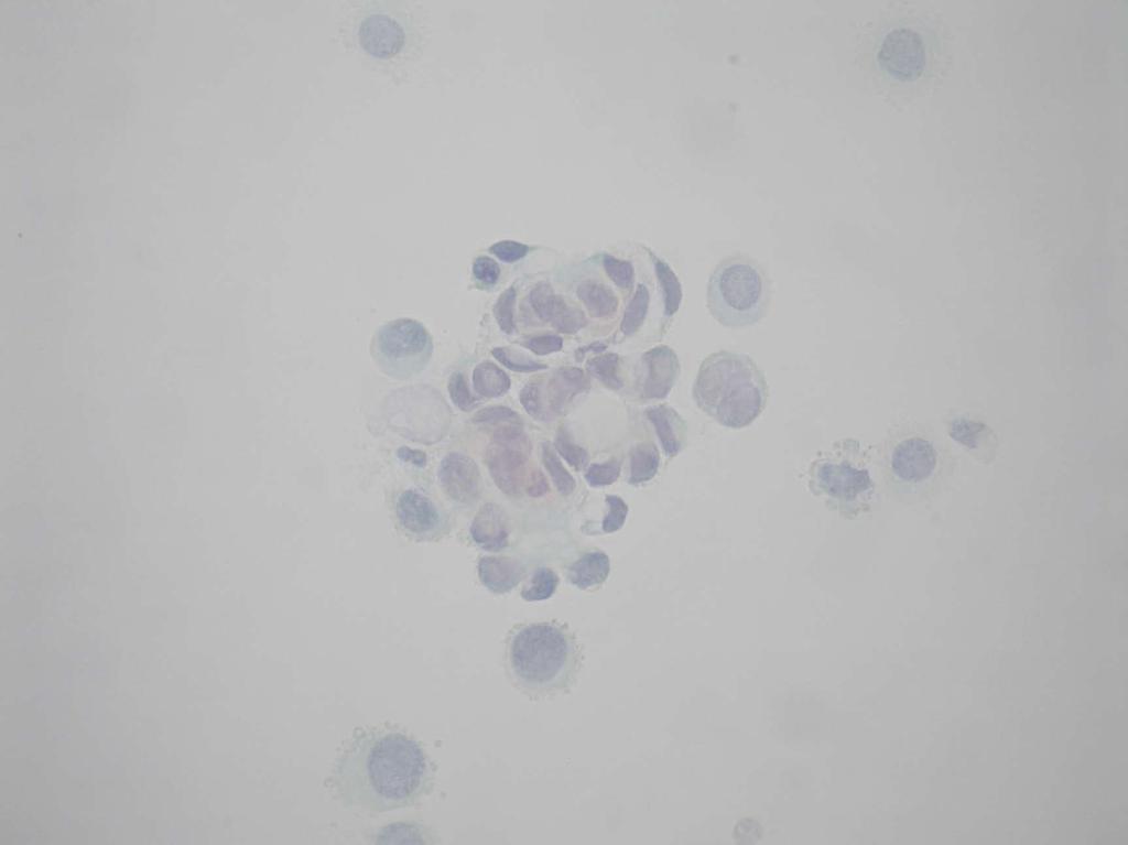 An irregular cluster of atypical cells. The cells show intermediate size, degeneration changes, indistinct cytoplasmic borders and moderate size of nuclei.