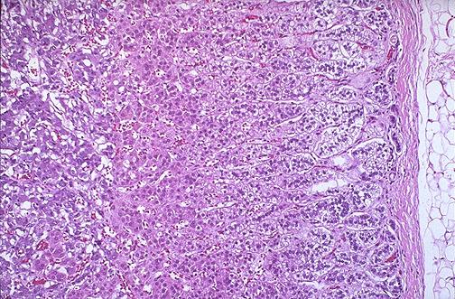 A. PHEOCHROMOCYTOMA CC/HPI : A 42 year old male visits his doctor for evaluation of sudden (paroxysmal) attacks of headache, sweating, and anxiety.