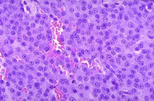 Questions for everyone to consider: Does this pituitary look normal? If not, what looks different about these cells? Questions if you have been assigned this case: This adenoma is producing prolactin.