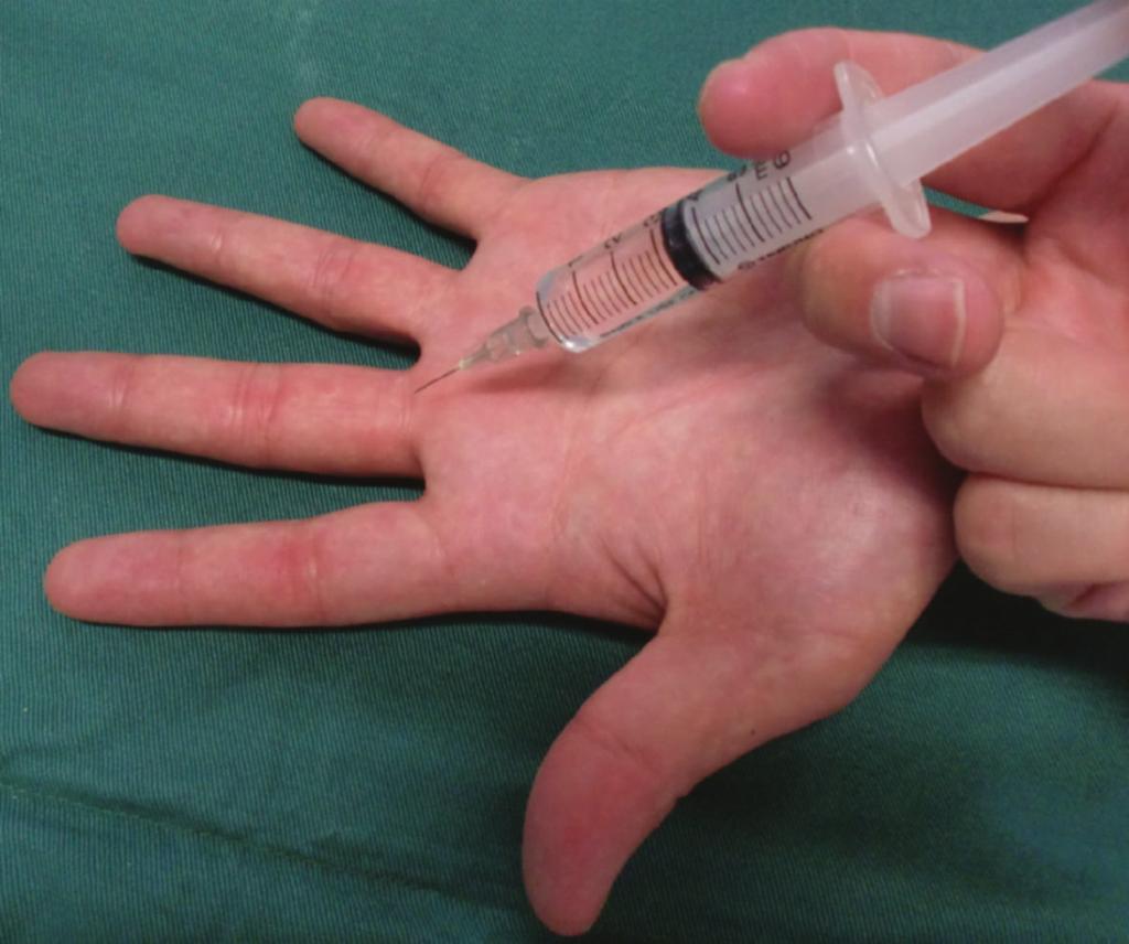 2 Anesthesiology Research and Practice Figure 1: Subcutaneous single injection at the middle point of the palmar digital crease. Figure 2: The area around the injection point is completely white.