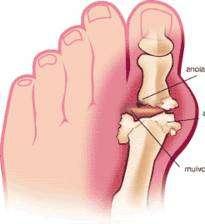Characteristics typical of gout but not of RA: Maintenance of joint