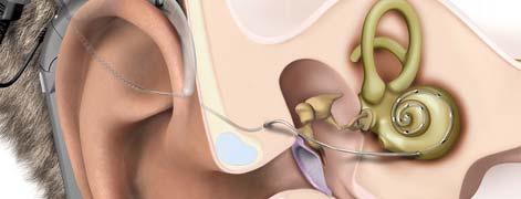 Cochlear Implants Background Areas in cochlear correspond to acoustic frequency Degradation of sound transmission in the inner ear can be bridged high