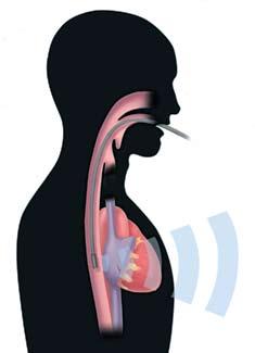 How TEE Works A flexible tube about the size of your index finger is inserted into your mouth and down your esophagus.