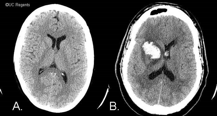 STAT Non-Contrast Head CT Two pts both present w/ L sided weakness: A.