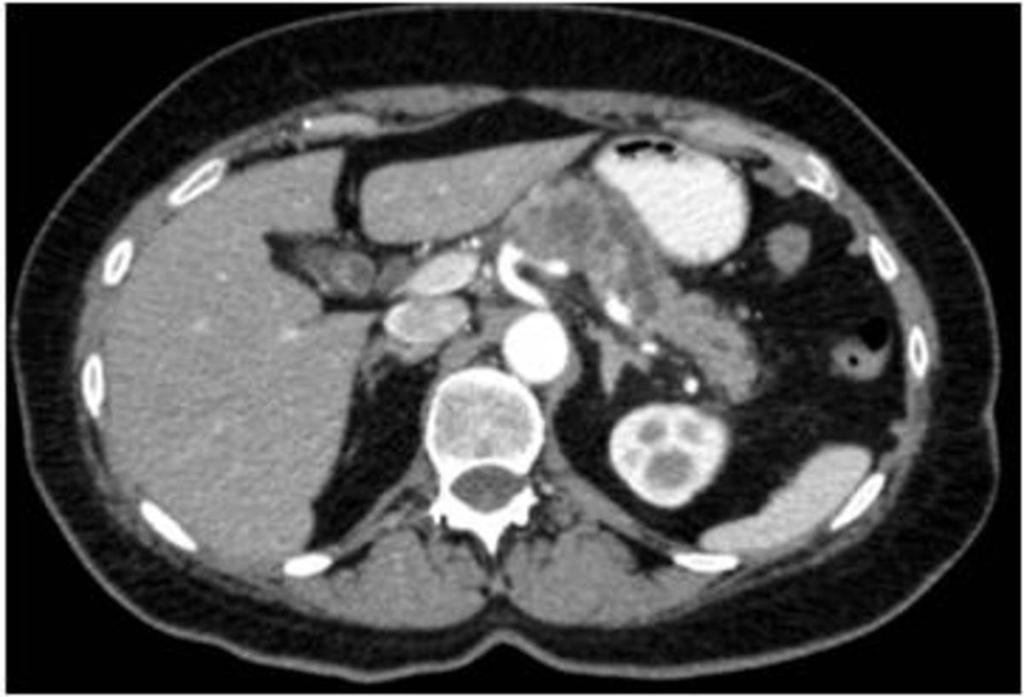 Fig. 19: Axial CT image showing pancreatic
