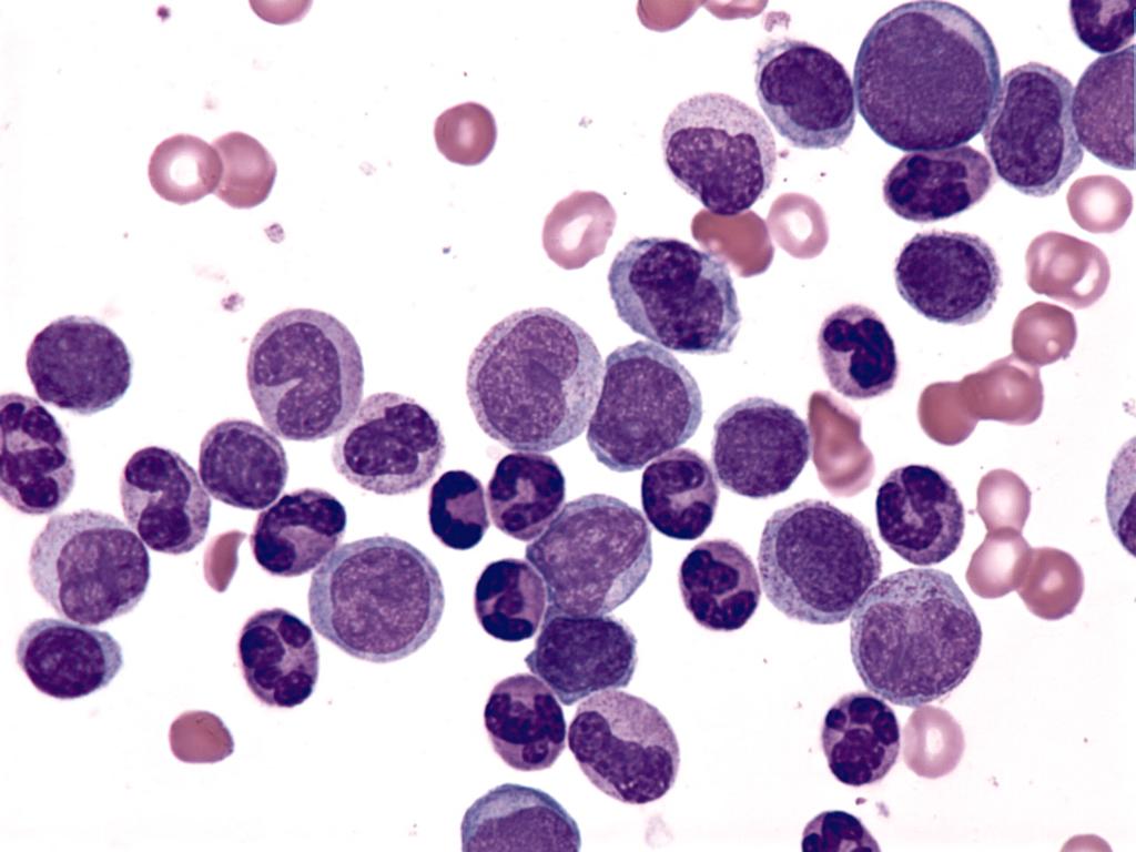 Accelerated Phase of CML - 4.