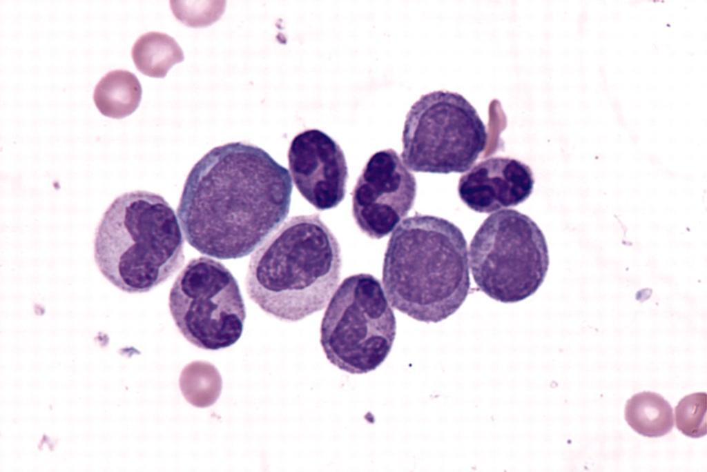 Accelerated Phase of CML - 2.