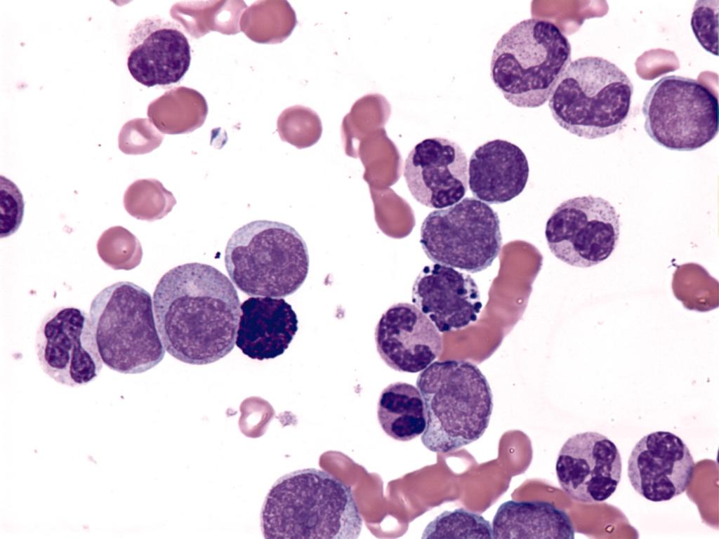 Accelerated Phase of CML - 3.