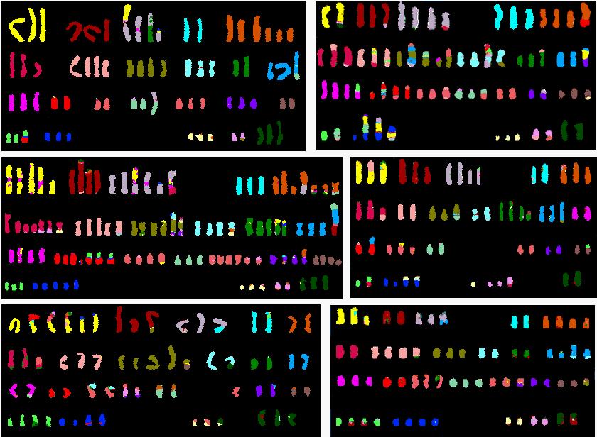 Chromosomes from six ovarian cancers showing: chromosomal instability A B 1 2 3 4 5 1 2 3 4 5 6 7 8 9 10 11