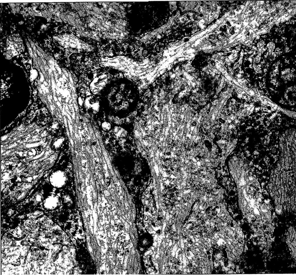Ultrastructural Features of Gaucher Disease 243 FIGURE 1 Electron micrograph showing intracytoplasmic, membrane-bound lysosomal inclusions in a case of classic Gaucher disease.
