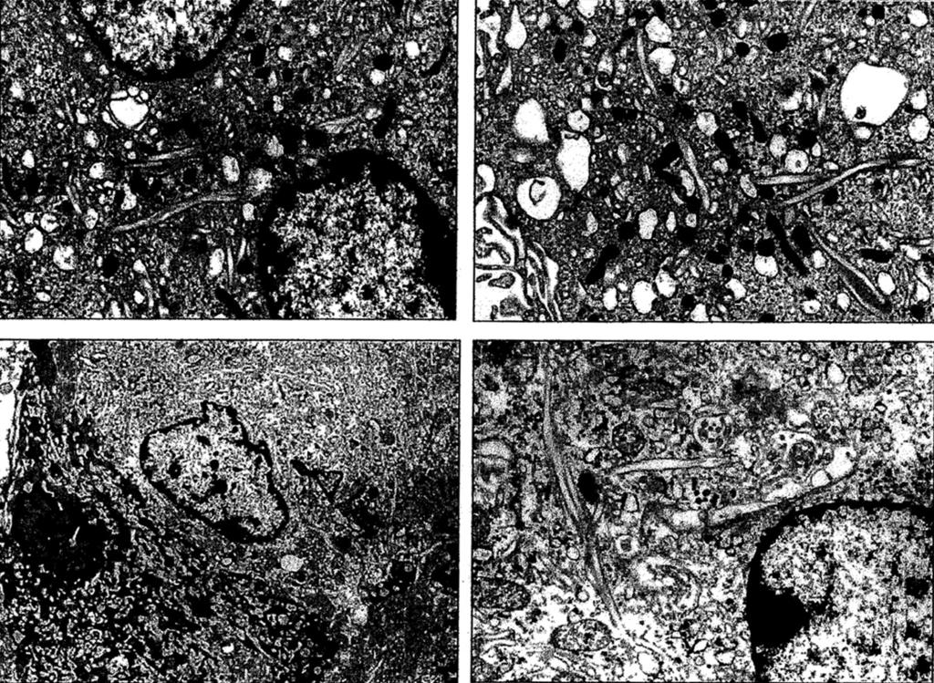 Ultrastructural Features of Gaucher Disease 245 FIGURE 3 Electron micrographs of storage cells from case 1 (top) and case 2 (bottom) from abdominal lymph nodes demonstrate scattered intracytoplasmic
