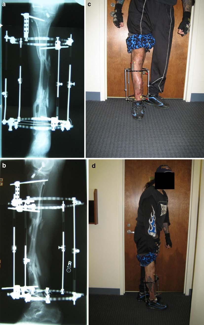 Fig. 5. a, b The AP/lateral views of the leg show progression of healing and alignment of the fibular transport.