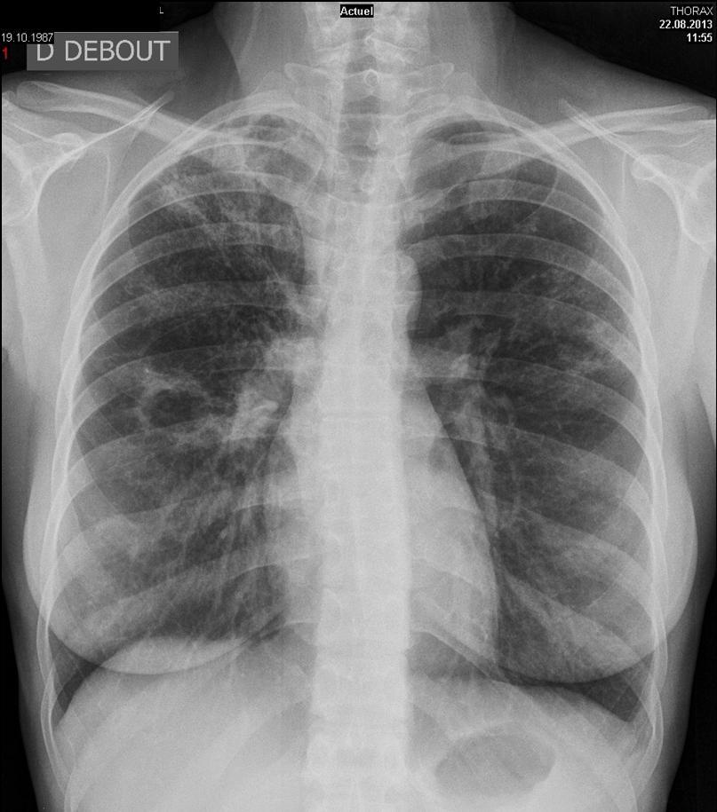 Same patient, 10 monthes after: infiltrate of the upper right lobe with cavern in the middle lobe.