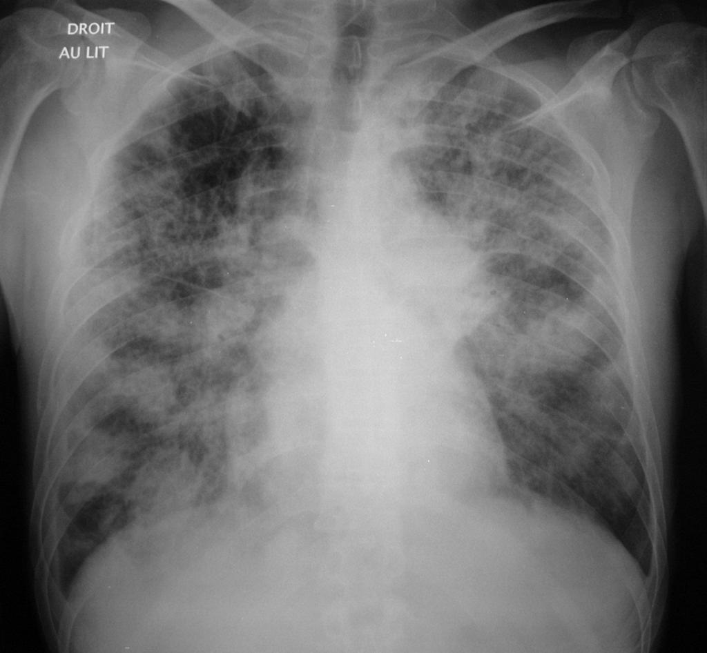 Case 6 Man, 42 years old, severe dyspnea and worsening condition.