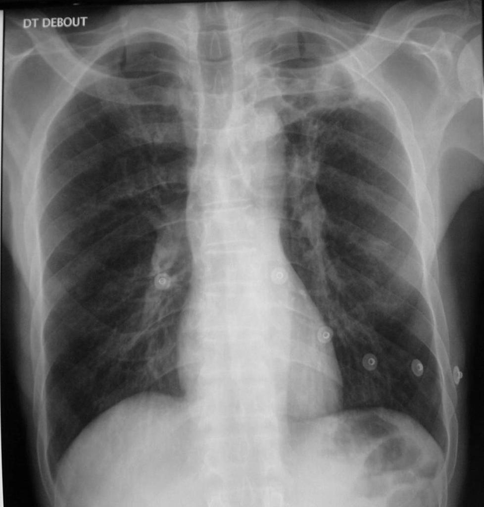 Case N 8 Same patient, November 2007. Hemoptisy with spontaneous improvment. Smear negative.