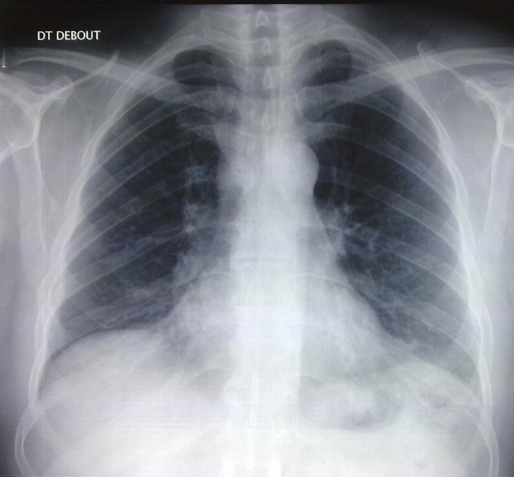 Case N 9 CXR: middle lobe opacity with retraction on the right side and enlargment of the