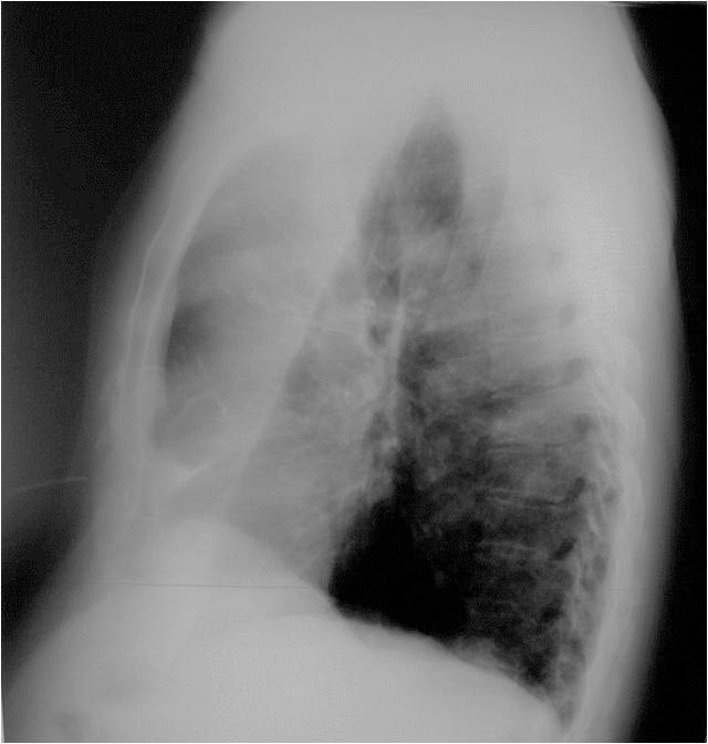 superior lung atelectasis.