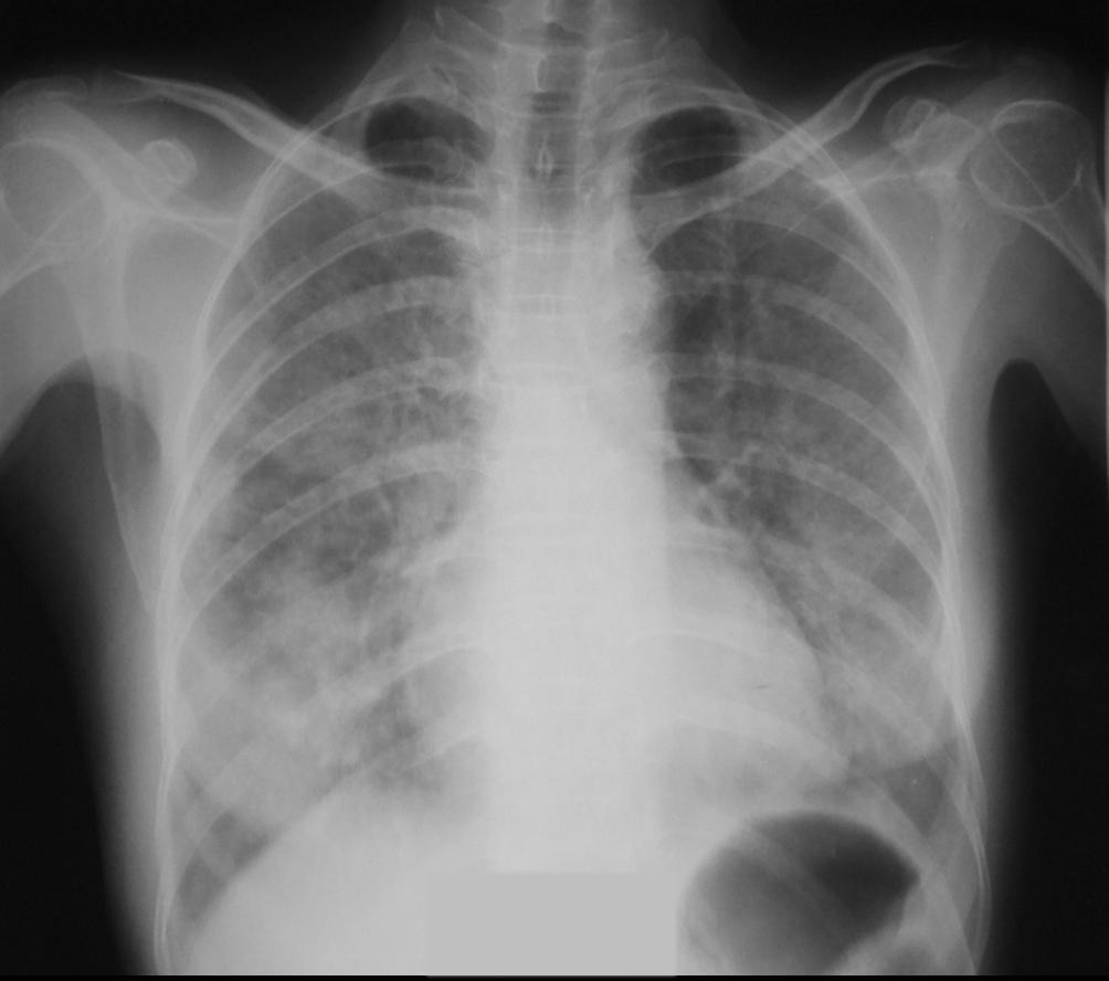 Case N 2 Diffuse, alveolar and interstitial pneumonia. Bacterial or viral pneumonia is possible.