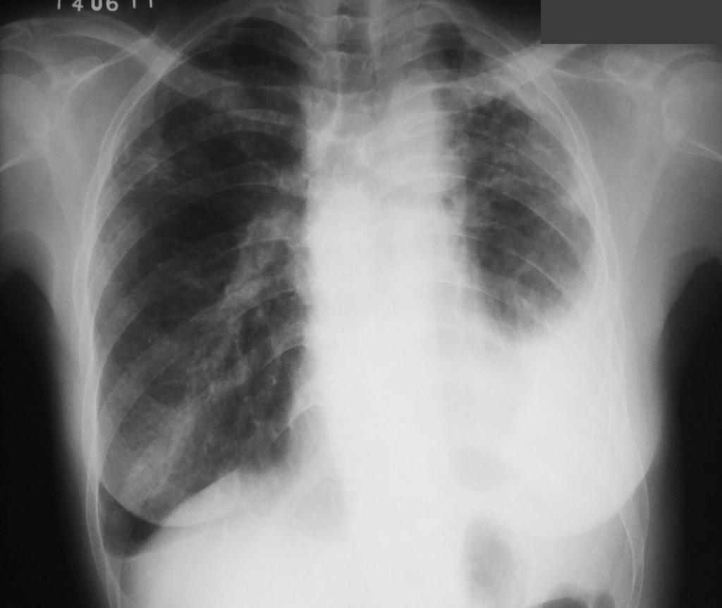 Case N 4 Left pleural effusion with right axillar and bilateral retro clavicular
