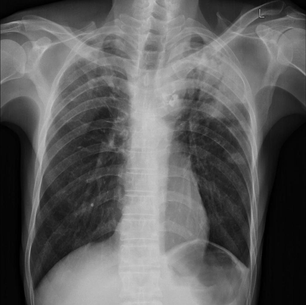 Case N 7 Left superior lobar pneumonia (with aeric bronchogram) and right superior lobe infiltrate.