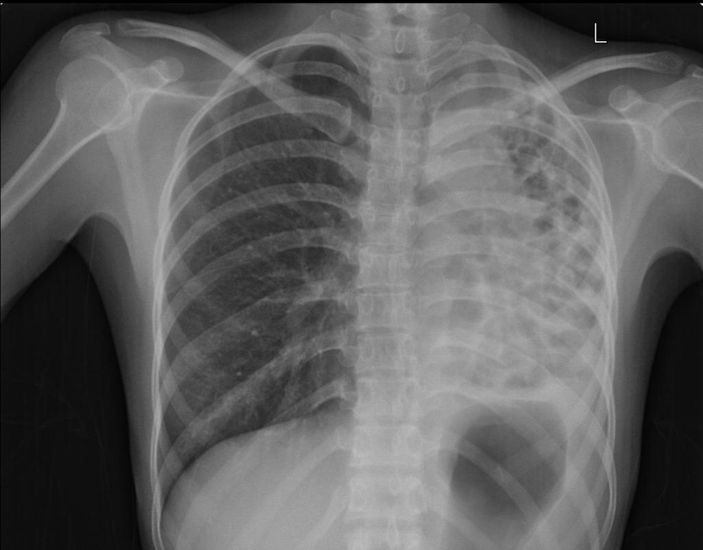 Case N 8 Diffuse bronchiectasis of the left lung, which is restracted and distroyed.